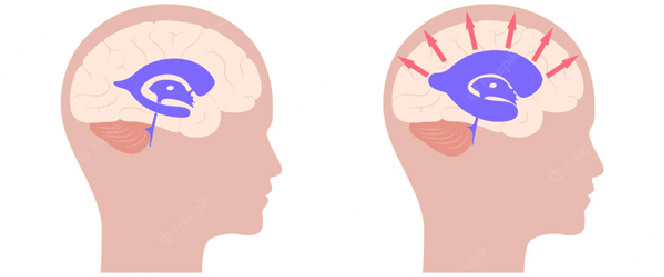 Hidrocefalia
