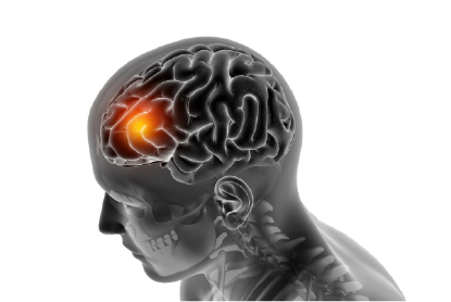 Tumores Cerebrales